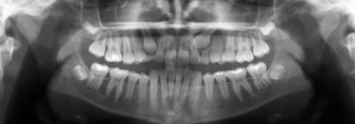 Impacted Canines | Oral & Maxillofacial Surgery | OMS Nashville