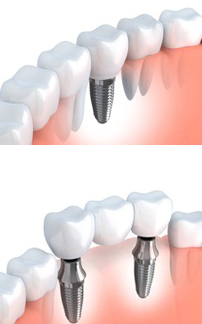 Dental Implants Surgical Oms Nashville - 