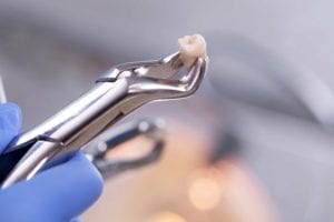 Oral Surgeon Wisdom Teeth